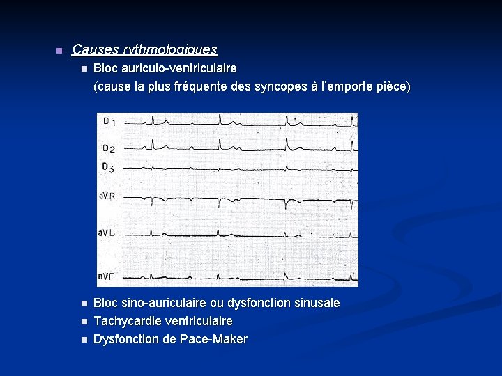 n Causes rythmologiques n Bloc auriculo-ventriculaire (cause la plus fréquente des syncopes à l’emporte n Causes rythmologiques n Bloc auriculo-ventriculaire (cause la plus fréquente des syncopes à l’emporte