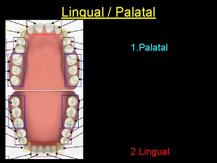 Lingual / Palatal 1. Palatal 2. Lingual 