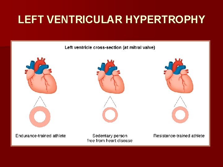 LEFT VENTRICULAR HYPERTROPHY 