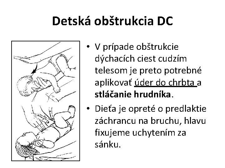 Detská obštrukcia DC • V prípade obštrukcie dýchacích ciest cudzím telesom je preto potrebné