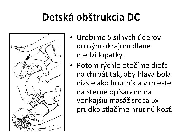 Detská obštrukcia DC • Urobíme 5 silných úderov dolným okrajom dlane medzi lopatky. •