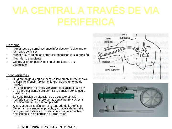 VIA CENTRAL A TRAVÉS DE VIA PERIFERICA Ventajas - Menor tasa de complicaciones infecciosas