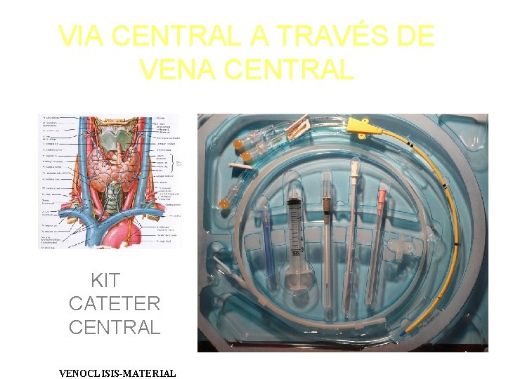 VIA CENTRAL A TRAVÉS DE VENA CENTRAL KIT CATETER CENTRAL VENOCLISIS-MATERIAL 