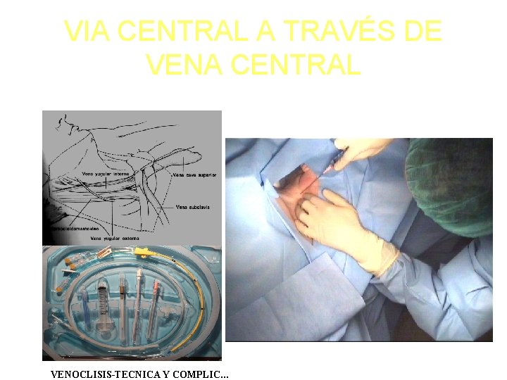 VIA CENTRAL A TRAVÉS DE VENA CENTRAL VENOCLISIS-TECNICA Y COMPLIC… 