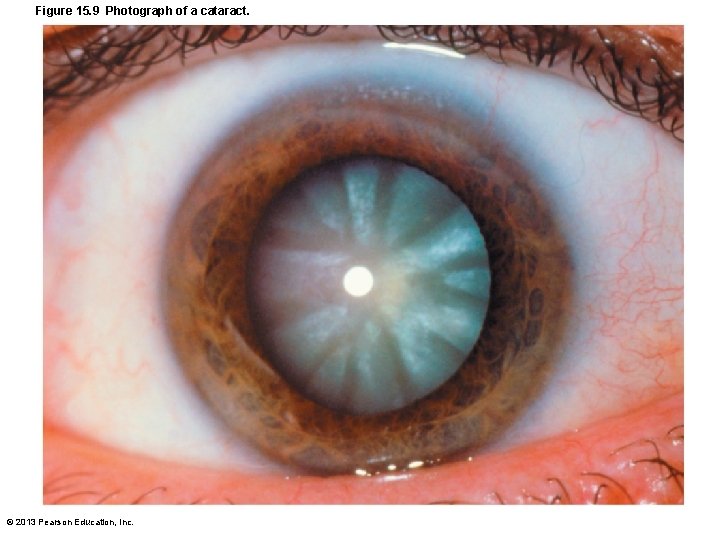 Figure 15. 9 Photograph of a cataract. © 2013 Pearson Education, Inc. 