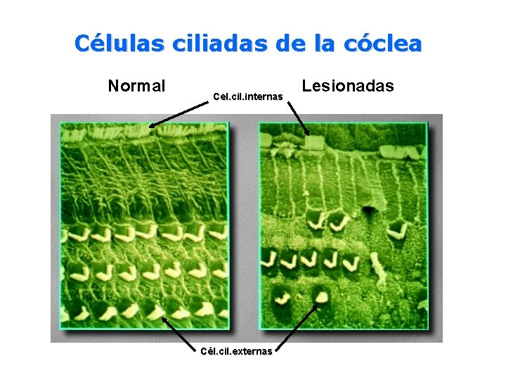 Células ciliadas de la cóclea Normal Cel. cil. internas Cél. cil. externas Lesionadas 
