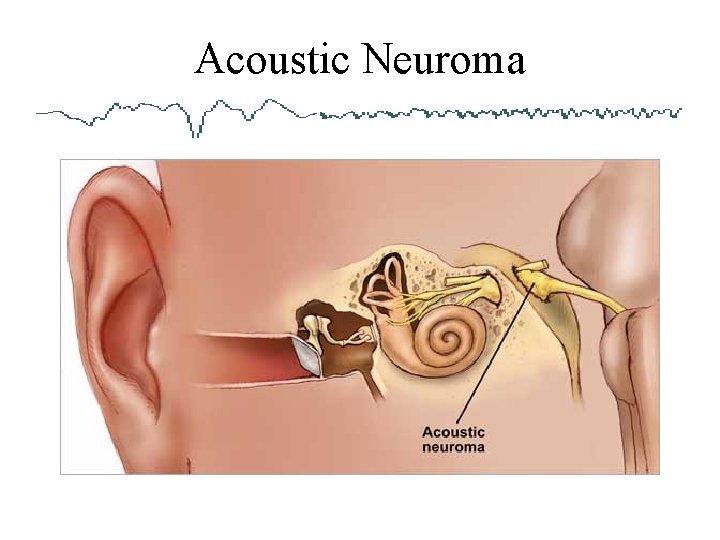 Acoustic Neuroma 