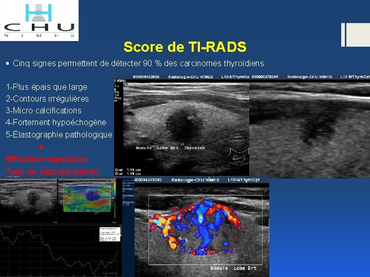 Score de TI-RADS § Cinq signes permettent de détecter 90 % des carcinomes thyroïdiens.