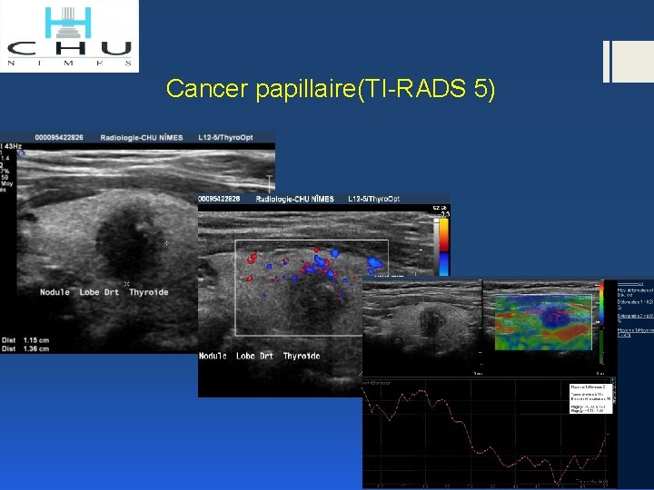 Cancer papillaire(TI-RADS 5) 