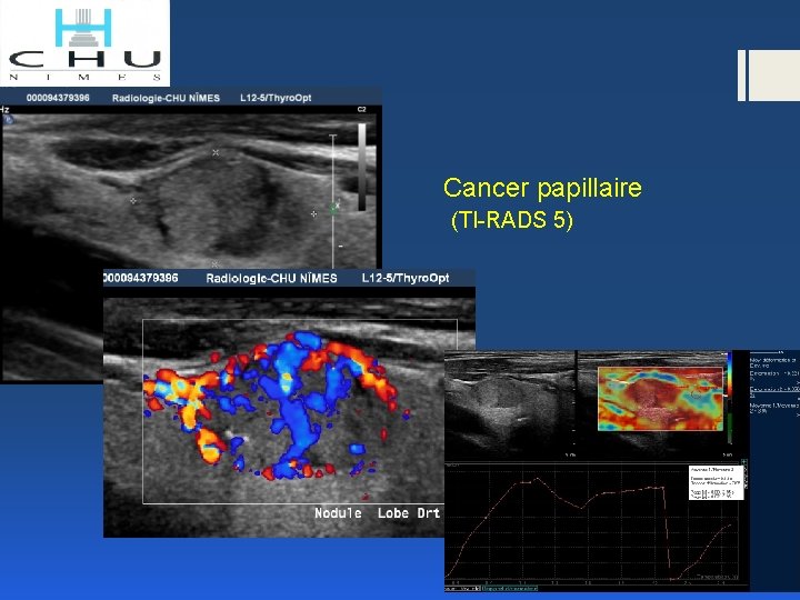  Cancer papillaire (TI-RADS 5) 