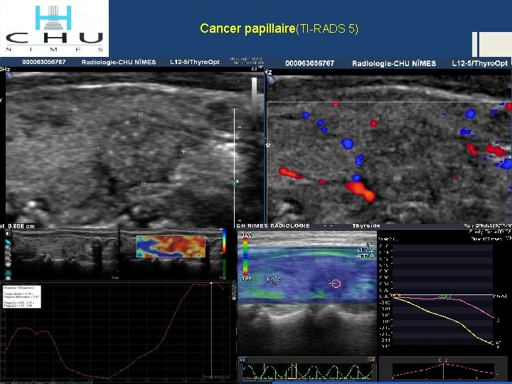 Cancer papillaire(TI-RADS 5) 