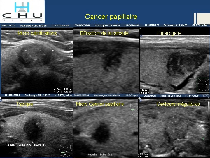 Cancer papillaire Micro calcifications Typique Effraction de la capsule Micro Cancer papillaire Hétérogène Contours
