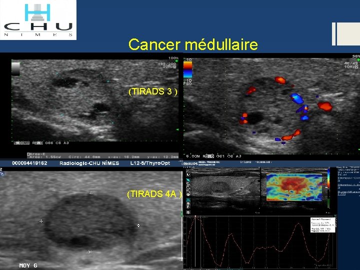 Cancer médullaire (TIRADS 3 ) (TIRADS 4 A ) 