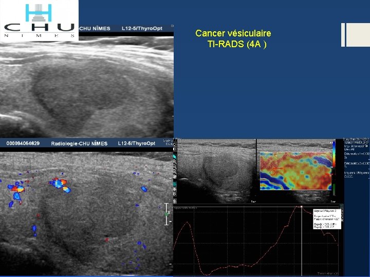  Cancer vésiculaire TI-RADS (4 A ) 