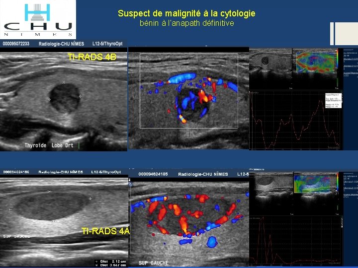 Suspect de malignité à la cytologie bénin à l’anapath définitive TI-RADS 4 B TI-RADS