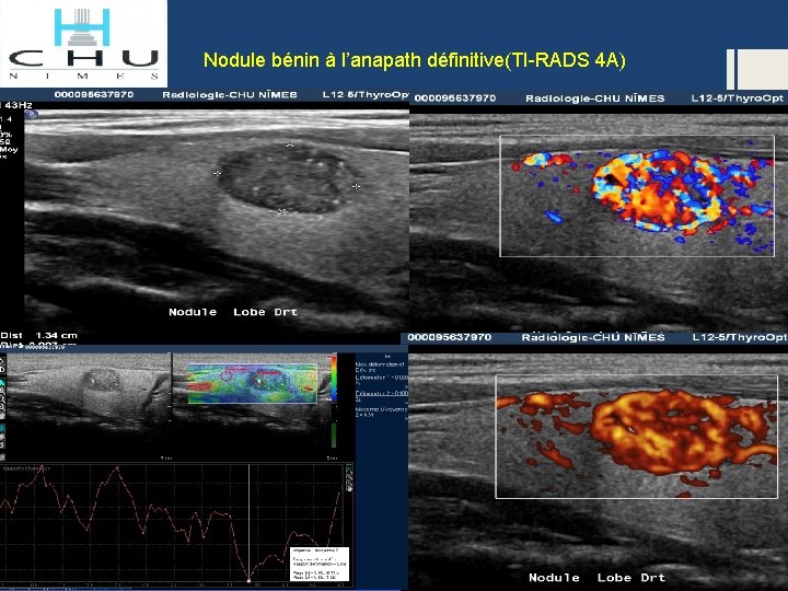 Nodule bénin à l’anapath définitive(TI-RADS 4 A) 