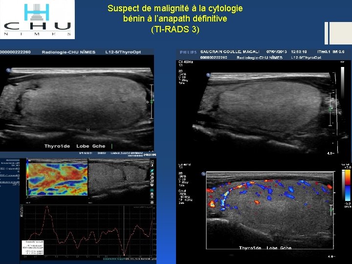 Suspect de malignité à la cytologie bénin à l’anapath définitive (TI-RADS 3) 