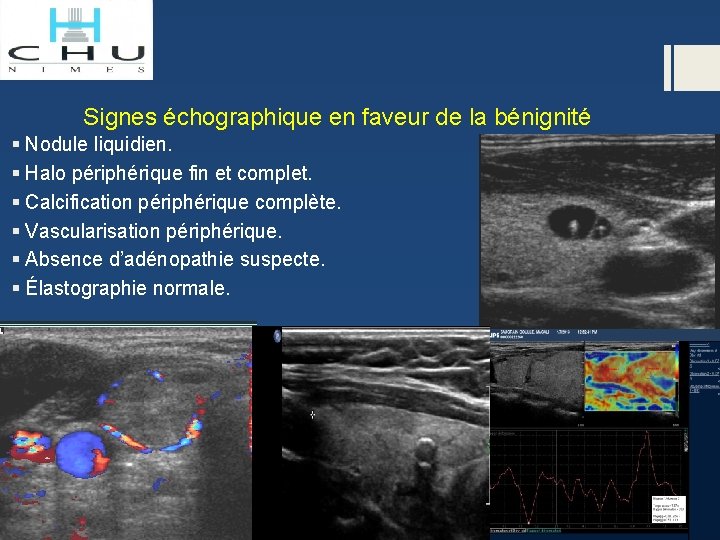 Signes échographique en faveur de la bénignité § Nodule liquidien. § Halo périphérique fin