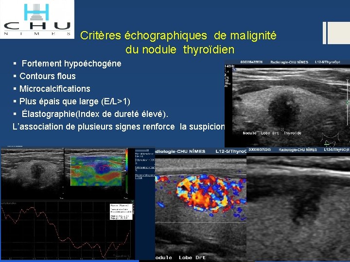 Critères échographiques de malignité du nodule thyroïdien § Fortement hypoéchogéne § Contours flous §