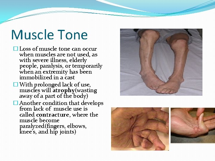 Muscle Tone � Loss of muscle tone can occur when muscles are not used,