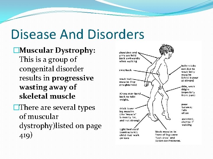 Disease And Disorders �Muscular Dystrophy: This is a group of congenital disorder results in