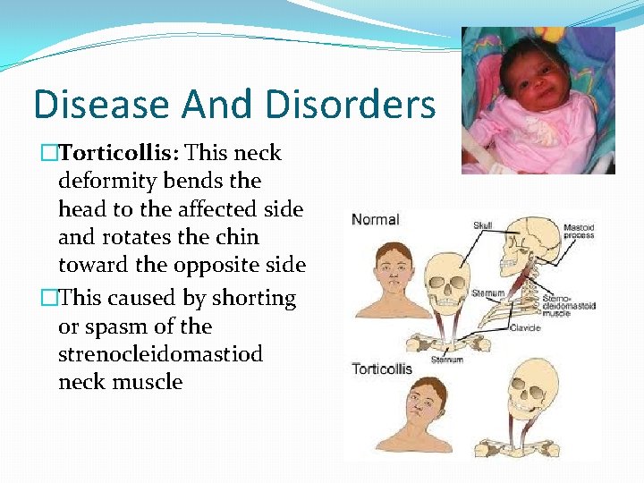 Disease And Disorders �Torticollis: This neck deformity bends the head to the affected side