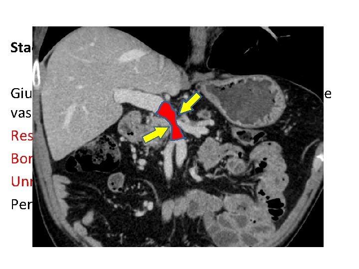 Stadiazione locale: Giudizio di resecabilità sulla base dell’infiltrazione vascolare Resectable Borderline resectable Unresectable perchè