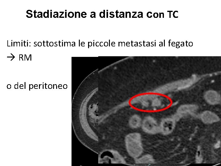 Stadiazione a distanza con TC Limiti: sottostima le piccole metastasi al fegato RM o