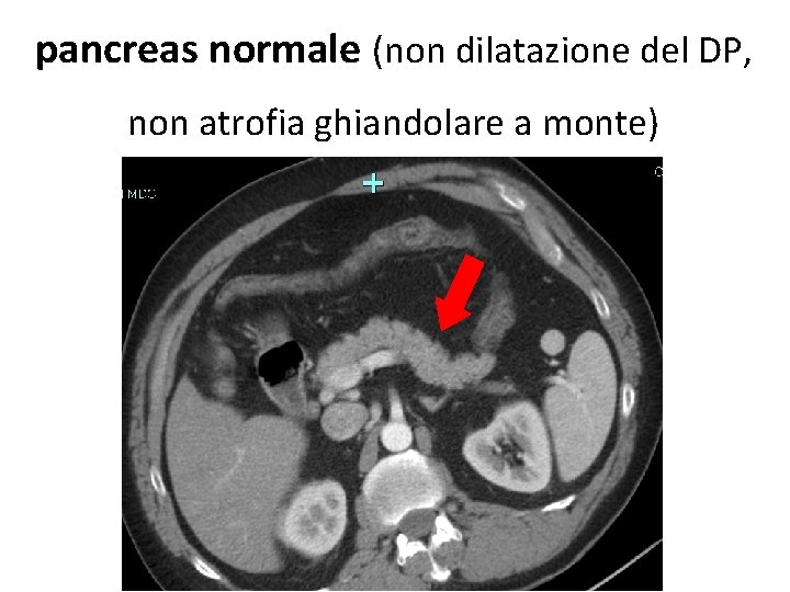 pancreas normale (non dilatazione del DP, non atrofia ghiandolare a monte) 