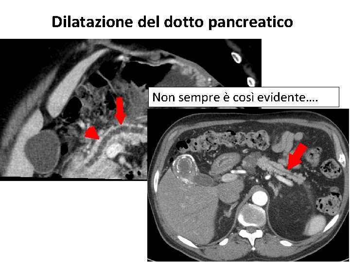 Dilatazione del dotto pancreatico Non sempre è così evidente…. 