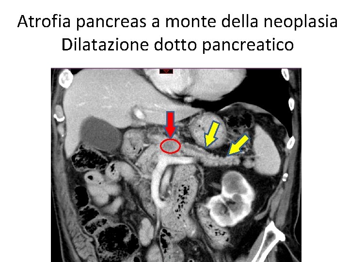 Atrofia pancreas a monte della neoplasia Dilatazione dotto pancreatico 