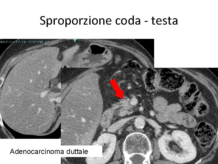 Sproporzione coda - testa Adenocarcinoma duttale 