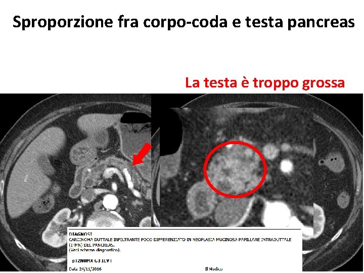 Sproporzione fra corpo-coda e testa pancreas La testa è troppo grossa 