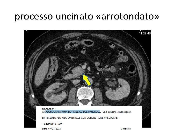 processo uncinato «arrotondato» 