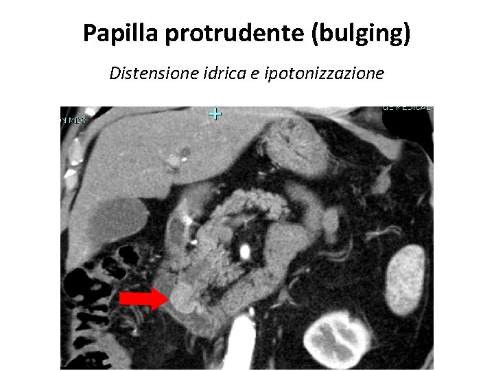 Papilla protrudente (bulging) Distensione idrica e ipotonizzazione 