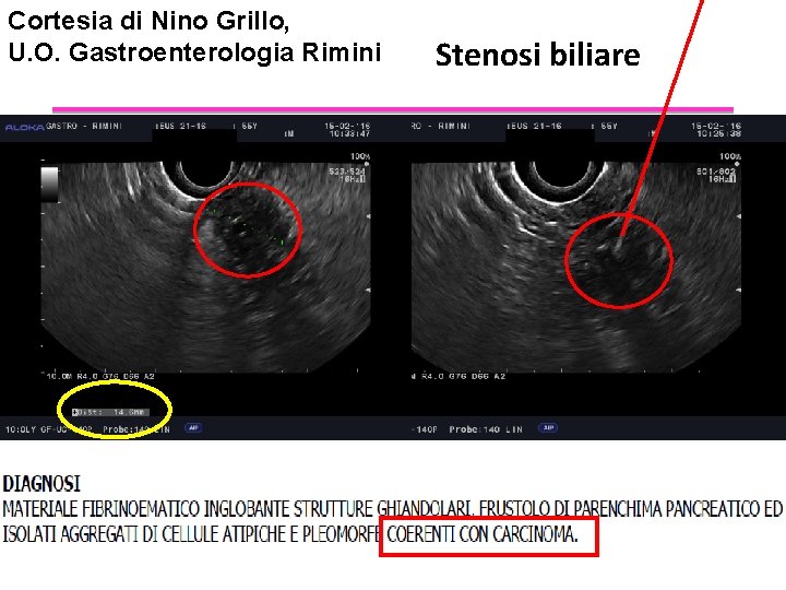Cortesia di Nino Grillo, U. O. Gastroenterologia Rimini Stenosi biliare 