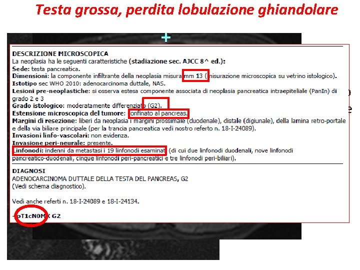 Testa grossa, perdita lobulazione ghiandolare Interruzione del dotto pancreatico principale Dilatazione a monte del