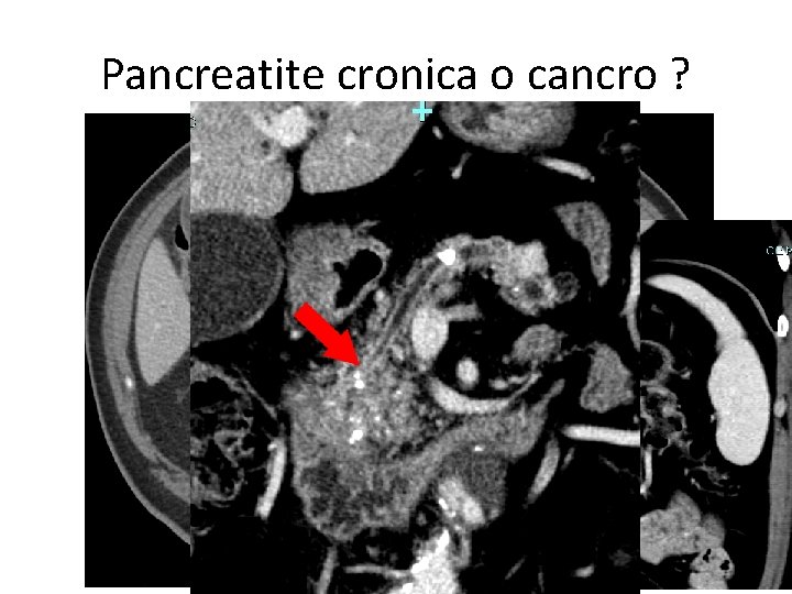 Pancreatite cronica o cancro ? 