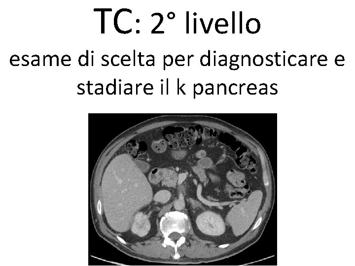 TC: 2° livello esame di scelta per diagnosticare e stadiare il k pancreas 