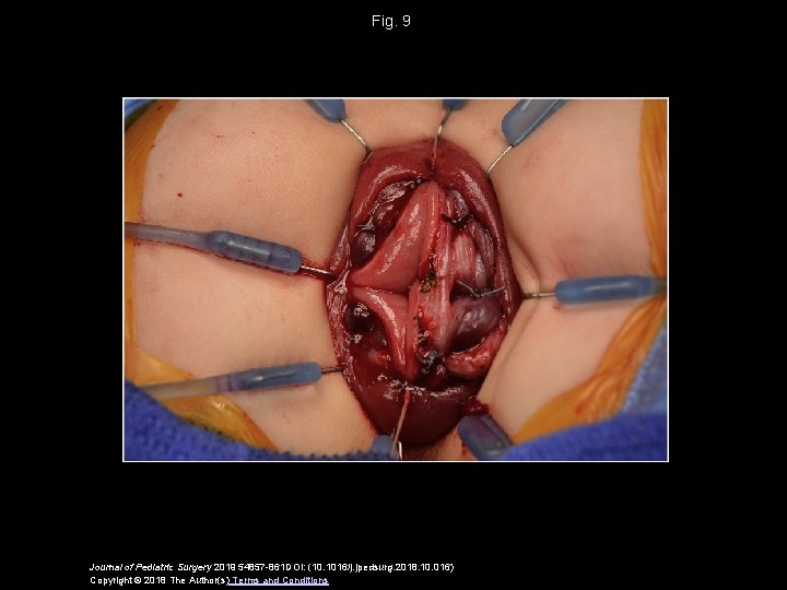 Fig. 9 Journal of Pediatric Surgery 2019 54857 -861 DOI: (10. 1016/j. jpedsurg. 2018. Fig. 9 Journal of Pediatric Surgery 2019 54857 -861 DOI: (10. 1016/j. jpedsurg. 2018.