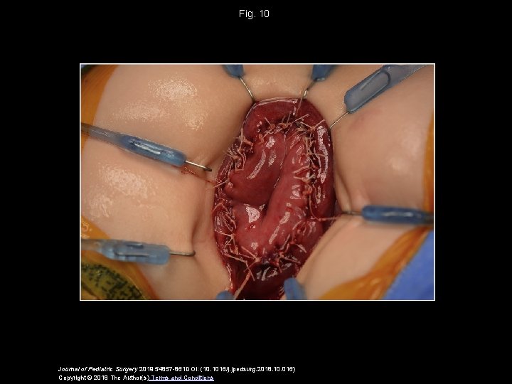 Fig. 10 Journal of Pediatric Surgery 2019 54857 -861 DOI: (10. 1016/j. jpedsurg. 2018. Fig. 10 Journal of Pediatric Surgery 2019 54857 -861 DOI: (10. 1016/j. jpedsurg. 2018.