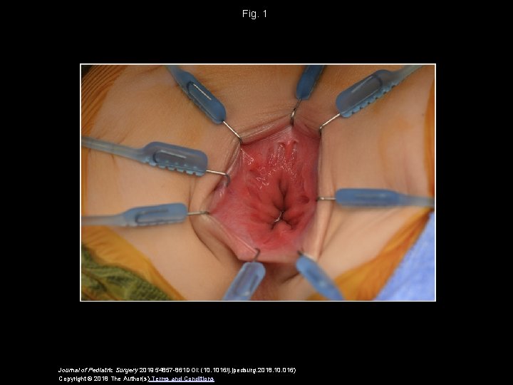 Fig. 1 Journal of Pediatric Surgery 2019 54857 -861 DOI: (10. 1016/j. jpedsurg. 2018. Fig. 1 Journal of Pediatric Surgery 2019 54857 -861 DOI: (10. 1016/j. jpedsurg. 2018.