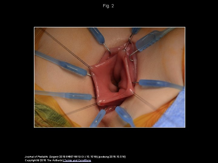 Fig. 2 Journal of Pediatric Surgery 2019 54857 -861 DOI: (10. 1016/j. jpedsurg. 2018. Fig. 2 Journal of Pediatric Surgery 2019 54857 -861 DOI: (10. 1016/j. jpedsurg. 2018.