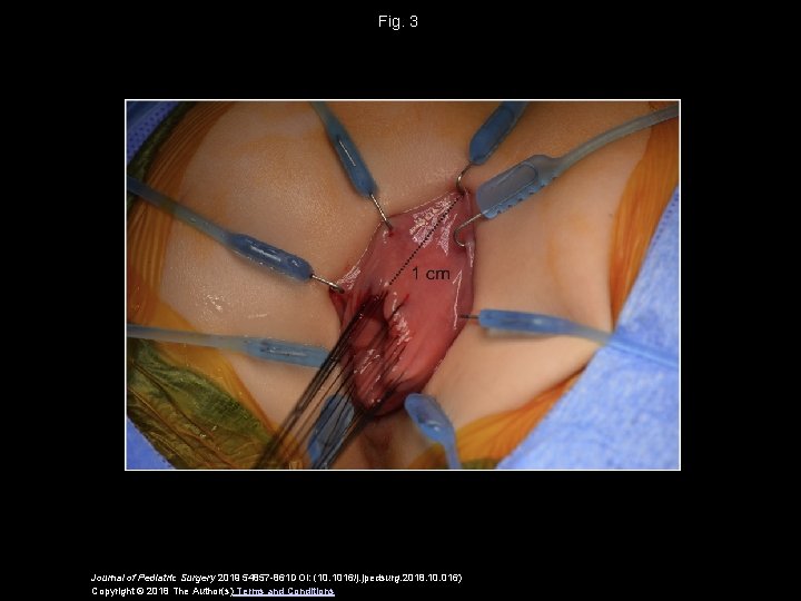 Fig. 3 Journal of Pediatric Surgery 2019 54857 -861 DOI: (10. 1016/j. jpedsurg. 2018. Fig. 3 Journal of Pediatric Surgery 2019 54857 -861 DOI: (10. 1016/j. jpedsurg. 2018.