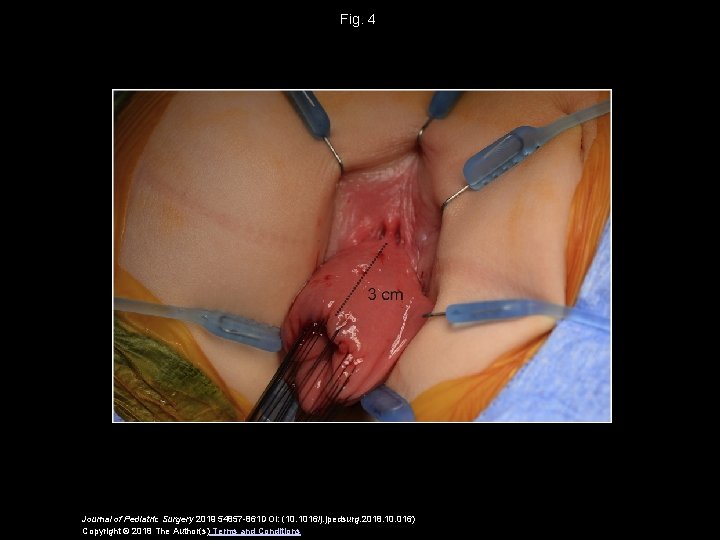 Fig. 4 Journal of Pediatric Surgery 2019 54857 -861 DOI: (10. 1016/j. jpedsurg. 2018. Fig. 4 Journal of Pediatric Surgery 2019 54857 -861 DOI: (10. 1016/j. jpedsurg. 2018.