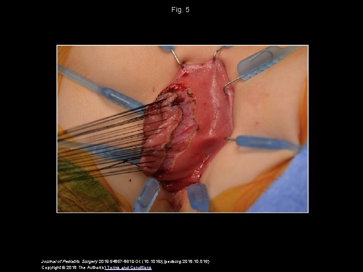 Fig. 5 Journal of Pediatric Surgery 2019 54857 -861 DOI: (10. 1016/j. jpedsurg. 2018. Fig. 5 Journal of Pediatric Surgery 2019 54857 -861 DOI: (10. 1016/j. jpedsurg. 2018.