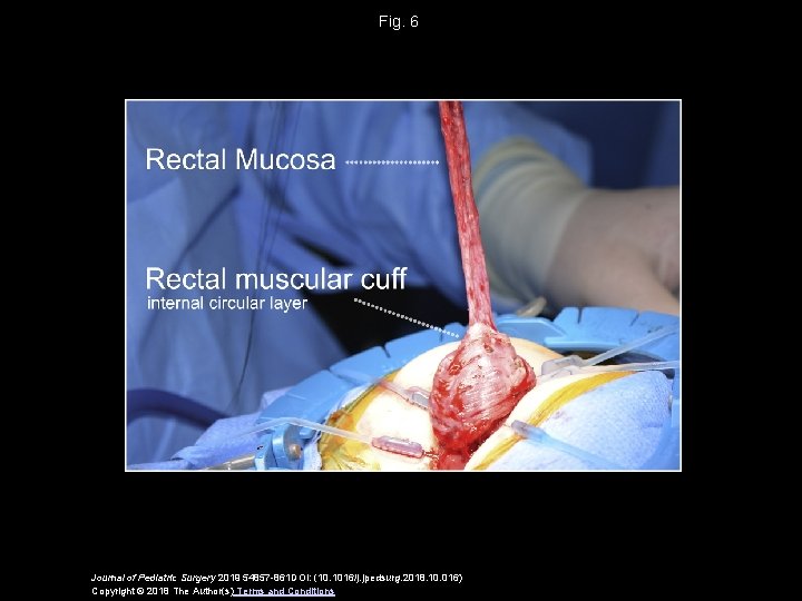 Fig. 6 Journal of Pediatric Surgery 2019 54857 -861 DOI: (10. 1016/j. jpedsurg. 2018. Fig. 6 Journal of Pediatric Surgery 2019 54857 -861 DOI: (10. 1016/j. jpedsurg. 2018.