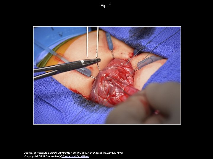 Fig. 7 Journal of Pediatric Surgery 2019 54857 -861 DOI: (10. 1016/j. jpedsurg. 2018. Fig. 7 Journal of Pediatric Surgery 2019 54857 -861 DOI: (10. 1016/j. jpedsurg. 2018.