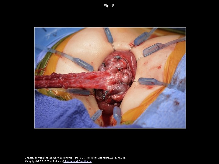 Fig. 8 Journal of Pediatric Surgery 2019 54857 -861 DOI: (10. 1016/j. jpedsurg. 2018. Fig. 8 Journal of Pediatric Surgery 2019 54857 -861 DOI: (10. 1016/j. jpedsurg. 2018.
