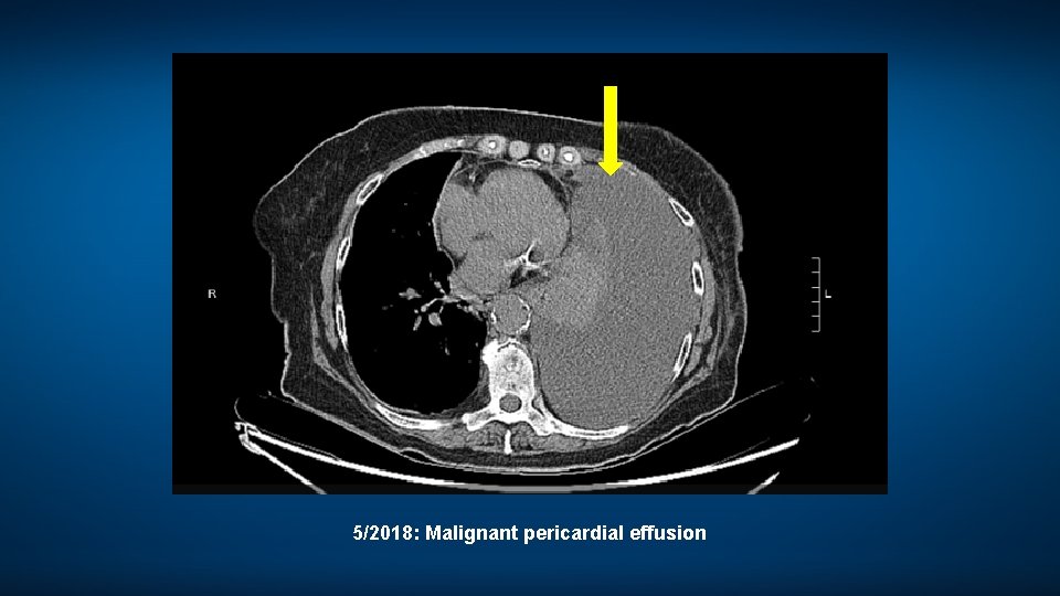 5/2018: Malignant pericardial effusion 